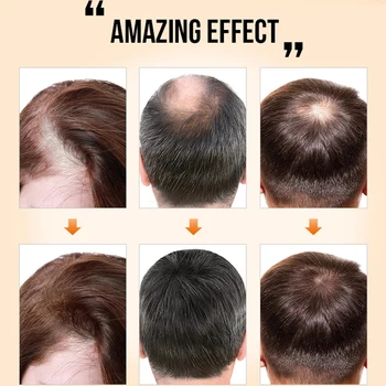 Спрейове за растежа на косата Джинджифил Essentials Продукти за мъже и жени Масло за бързо прераждане на косата и за лечение на кожата на главата Растежа на косата, Предпазва от косопад